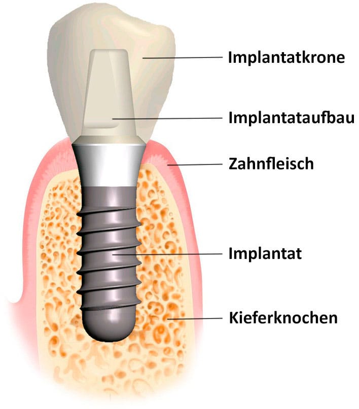 Implantat Zahnarztparxis Implantat Zahnarztparxis